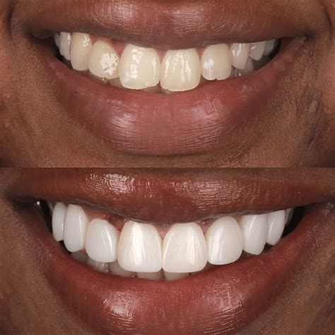 composite veneers near me|Iba pa.